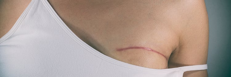 13 – Cirurgia de reconstrução mamária