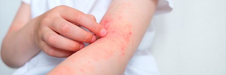 EFEITOS COLATERAIS DA IMUNOTERAPIA